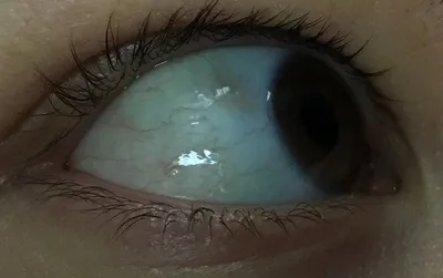 Что делать, если увидели на белке глаза красное пятно