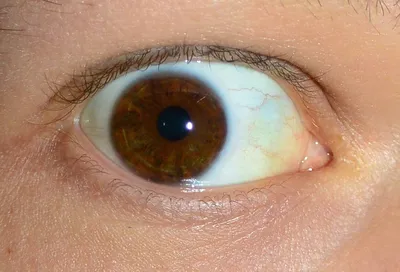 Опухоль глаза: симптомы и как можно ли вылечить новообразование