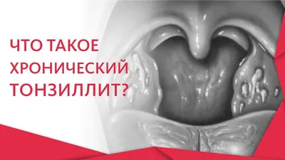 Ингаляции при ангине: небулайзер для детей, ингаляции при гнойной ангине |  Doc.ua