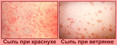 Идет запах у ребенка изо рта - почему может неприятно пахнуть гнилью:  причины сильного гнилостного воспаления в 2-3 года и у детей после 5 лет –  что делать, если резко появилась вонь