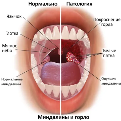 Вылечить тонзиллит (ангину) у ребенка в Уфе