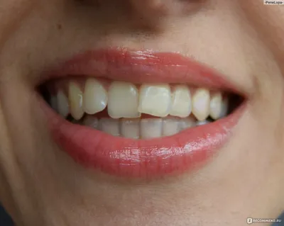 Ортодонтические пластины на зубы для исправления прикуса - «А вы знали, что  взрослым тоже можно выравнивать зубы с помощью пластинки и это в 20 раз  дешевле, чем брекеты! Отзыв о том, как