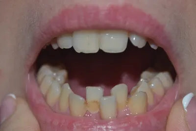 Брекеты для лечения скученности зубов
