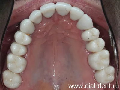 Протезирование зубов с исправлением неправильного прикуса - результат  ортодонтического лечения