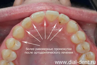 Комплексное улучшение вида передних зубов