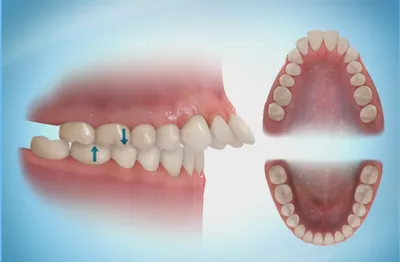 Протрузия зубов – причины и осложнения 🦷 Основные отличия между протрузией  и ретрузией 🦷 | CIS