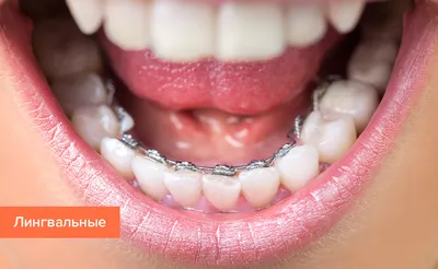 Брекеты на зубы — для чего нужны, стоит ли ставить, фото до и после, виды —  Startsmile
