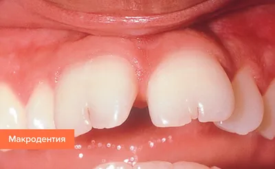 Большие зубы – причины и способы коррекции