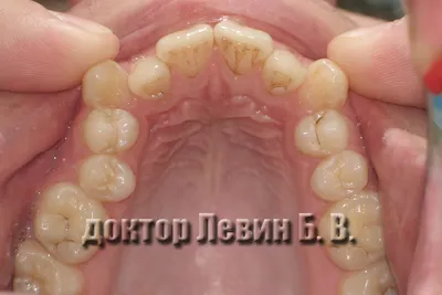 О стоматологии и не только...: Дистопия клыков. Ортодонтическое лечение  дистопии клыков с помощью брекетов.
