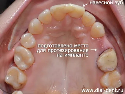 Исправление прикуса и имплантация зубов при адентии (отсутствии зубов)