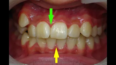 Кривые зубы, смещение средней линии, неровно растет клык. Как исправить?