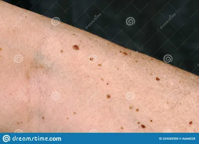 опасные или безвредные пигментные пятна на коже Стоковое Фото - изображение  насчитывающей болезнь, обесцвечивание: 224265550