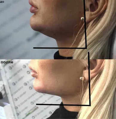 Подтянуть овал лица — записаться на коррекцию/контурную пластику овала лица  | Цена | Киев