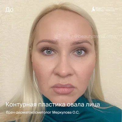 Моделирование овала лица филлерами в Москве | Цены, отзывы на процедуру в  клинике Beauty Trend