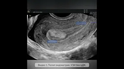 Видео 1. Полип эндометрия. УЗИ без ЦДК. - YouTube