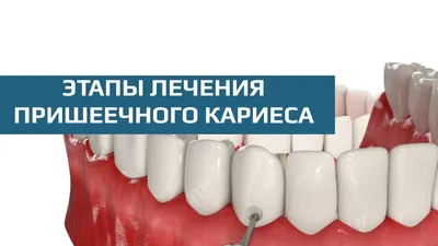 Цена лечения пришеечного кариеса передних зубов в Москве — стоматология  Lotus Dent