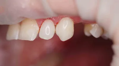 Пришеечный кариес, Волканов А.А.: выполненная работа с фото до и после в  стоматологии OneDent