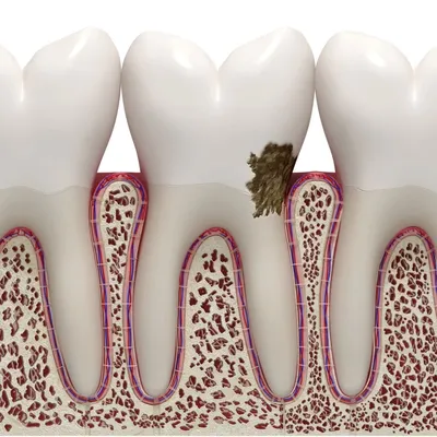 Пришеечный кариес зубов, лечение кариеса