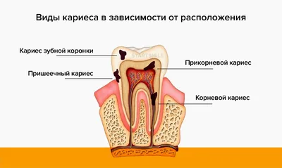 Кариес корня зуба: симптомы и лечение | Журнал Startsmile о стоматологии |  Дзен