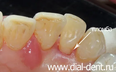 Удаление зубного налета и лечение кариеса зубов