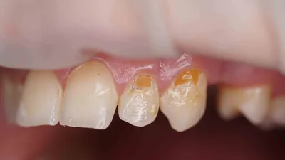 Пришеечный кариес, Волканов А.А.: выполненная работа с фото до и после в  стоматологии OneDent