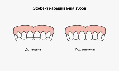 Протезы на передние зубы фото