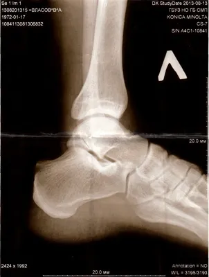 Фото рентгена стопы - Вопрос ортопеду-травматологу - 03 Онлайн