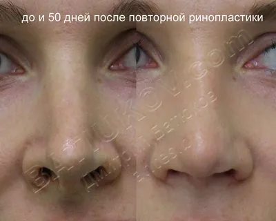 Повторная ринопластика в Минске, фото до и после