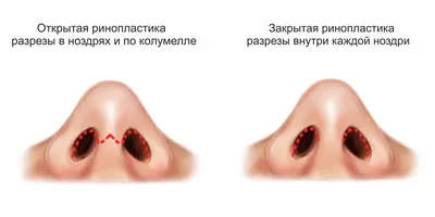 Ринопластика (пластика носа)