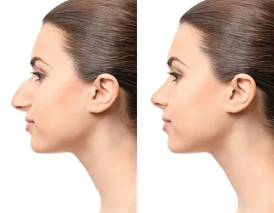 Ринопластика - пластическая хирургия носа исправление перегородки