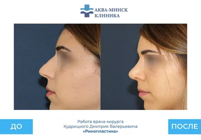 Ринопластика - исправление формы носа - Медицинский центр «Аква-Минск»