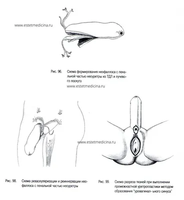 Операция по смене пола из мужчины, из женщины | Интернет-журнал  Estetmedicina.ru