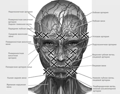 Опасные зоны при введении филлеров | Лицо, Рубцы, Кровеносные сосуды
