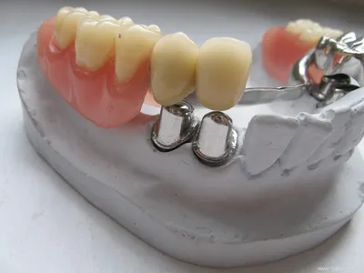 Съемное протезирование зубов, съемные зубные протезы: виды и цены в СПб -  Анле-Дент