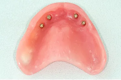 Съемное протезирование при полной потере зубов