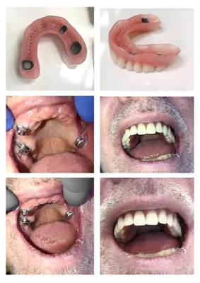 Комбинированное протезирование зубов | стоматологическая клиника Нардент