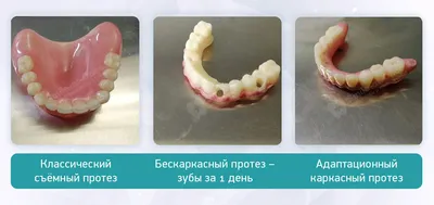 Зубные протезы нового поколения без неба - цена в Москве