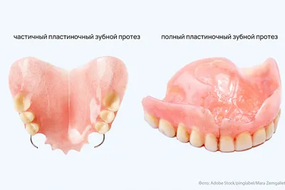 Что такое пластинчатые протезы для зубов: преимущества, виды  протезирования, особенности