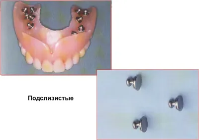 Съемные зубные протезы на имплантатах. Клиника профессора Абакарова