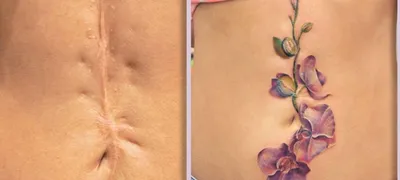 Маскировка следов от абдоминопластики с помощью татуировок