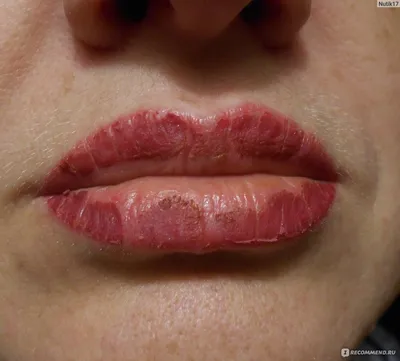 Шелушение губ после перманентного макияжа - 40 фото