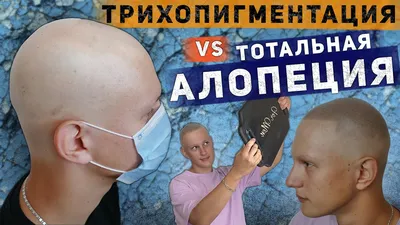 Трихопигментация vs Тотальная алопеция. Scalp micropigmentation by Andrey  Afanasev - YouTube