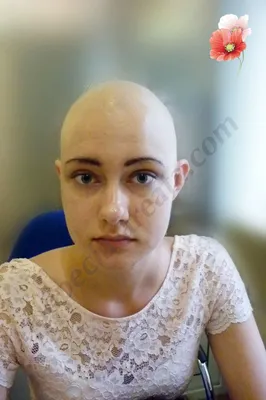 Болеет с 3-х летнего возраста. alopecia totalis (тотальная алопеция)  Обратилась в клинику в 18-ти летнем возрасте, через 15 лет от начала  развития заболева… | Cejas