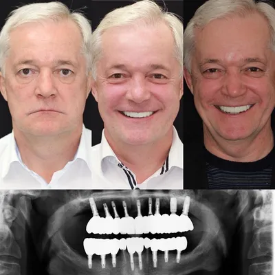 Тотальная имплантация при полной потере зубов в Москве | НК Клиник