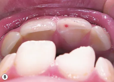 Эндодонтические аспекты лечения зубов после травмы – STOMWEB.RU