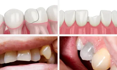 Травма зуба: что это, и как необходимо действовать? | Журнал Startsmile о  стоматологии | Дзен