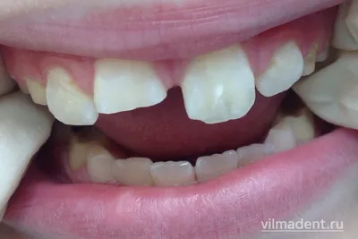 Травма зуба - ВилмаДент