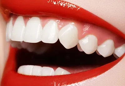 Здоровые дёсны - крепкие зубы - Hellas Dental