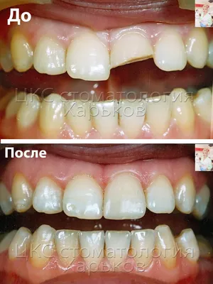 Травма зуба, перелом коронковой части переднего зуба. Реставрация  фотополимером