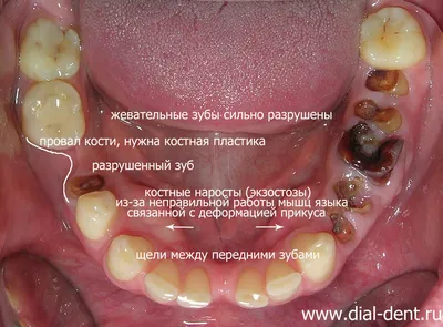 Протезирование на имплантах с изменением высоты прикуса и реставрацией  зубов керамикой